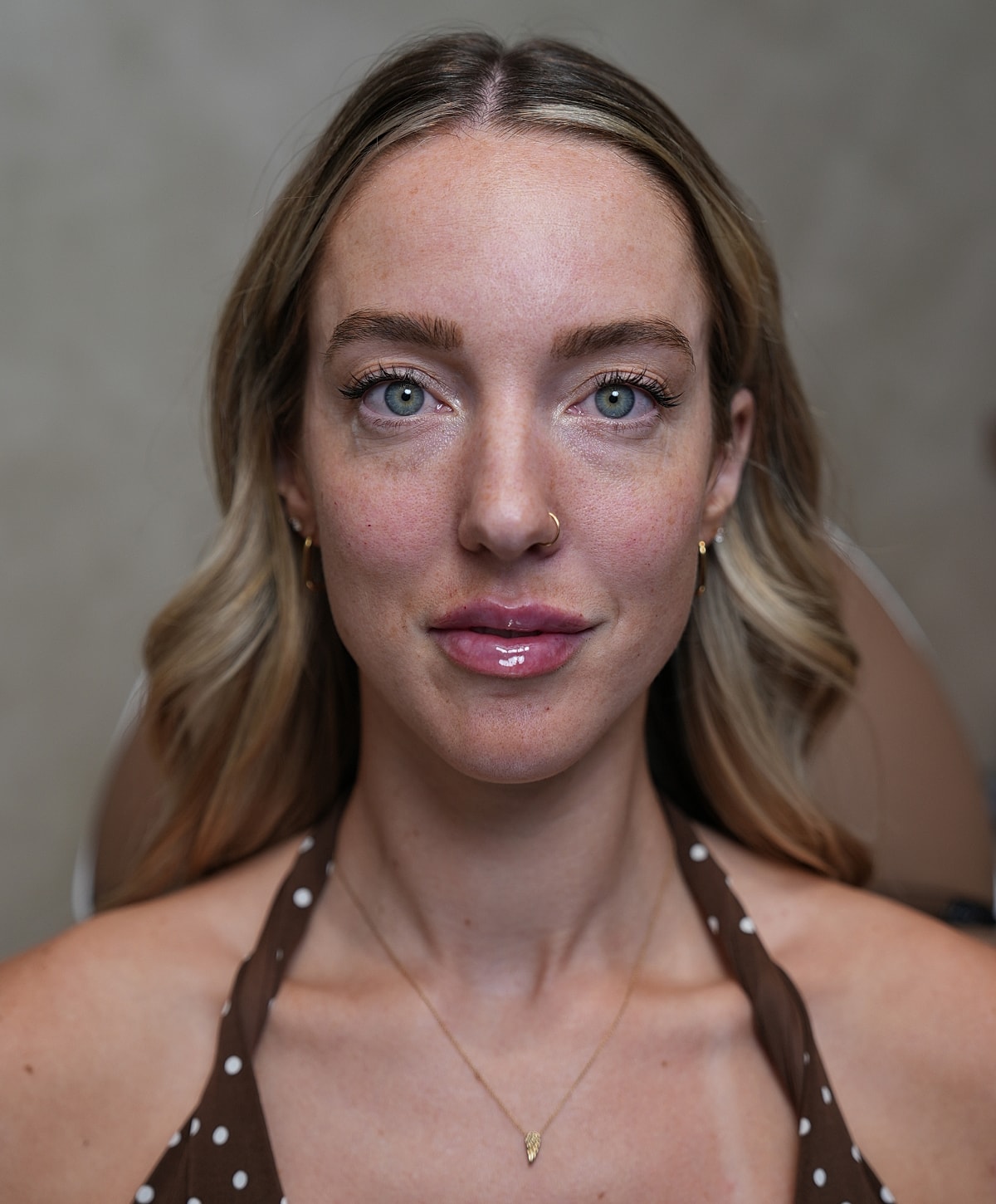 Del Mar dermal fillers model with blonde hair and green eyes.
