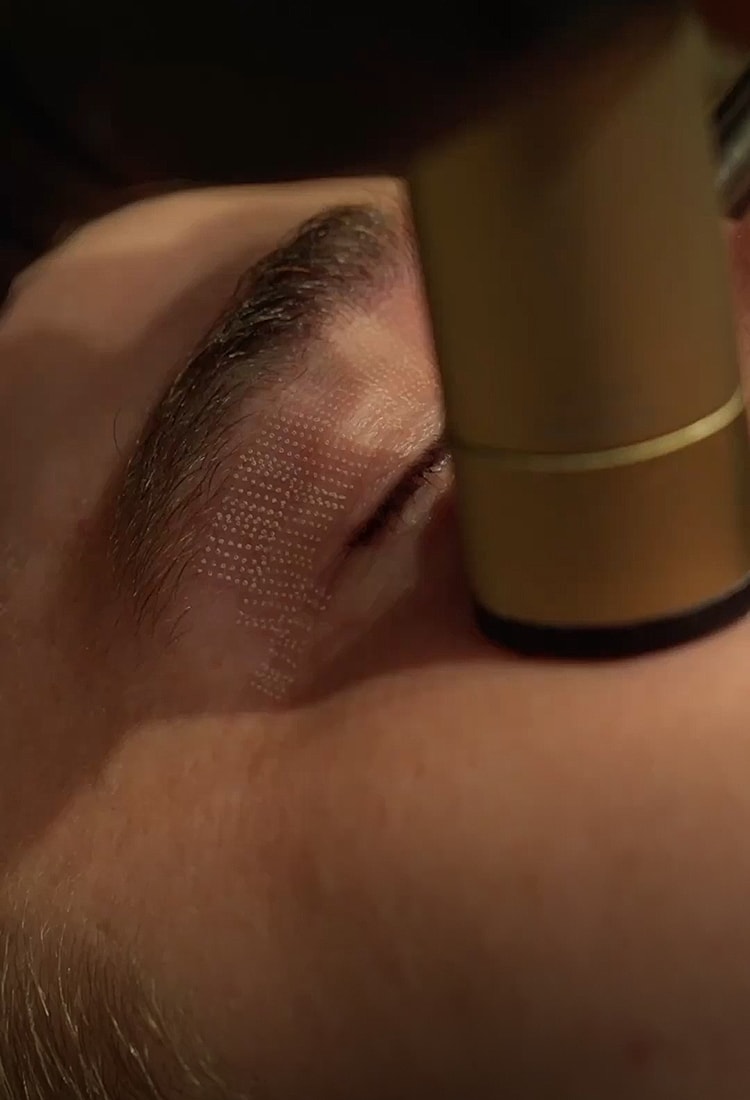Microscope examining an eye detail.